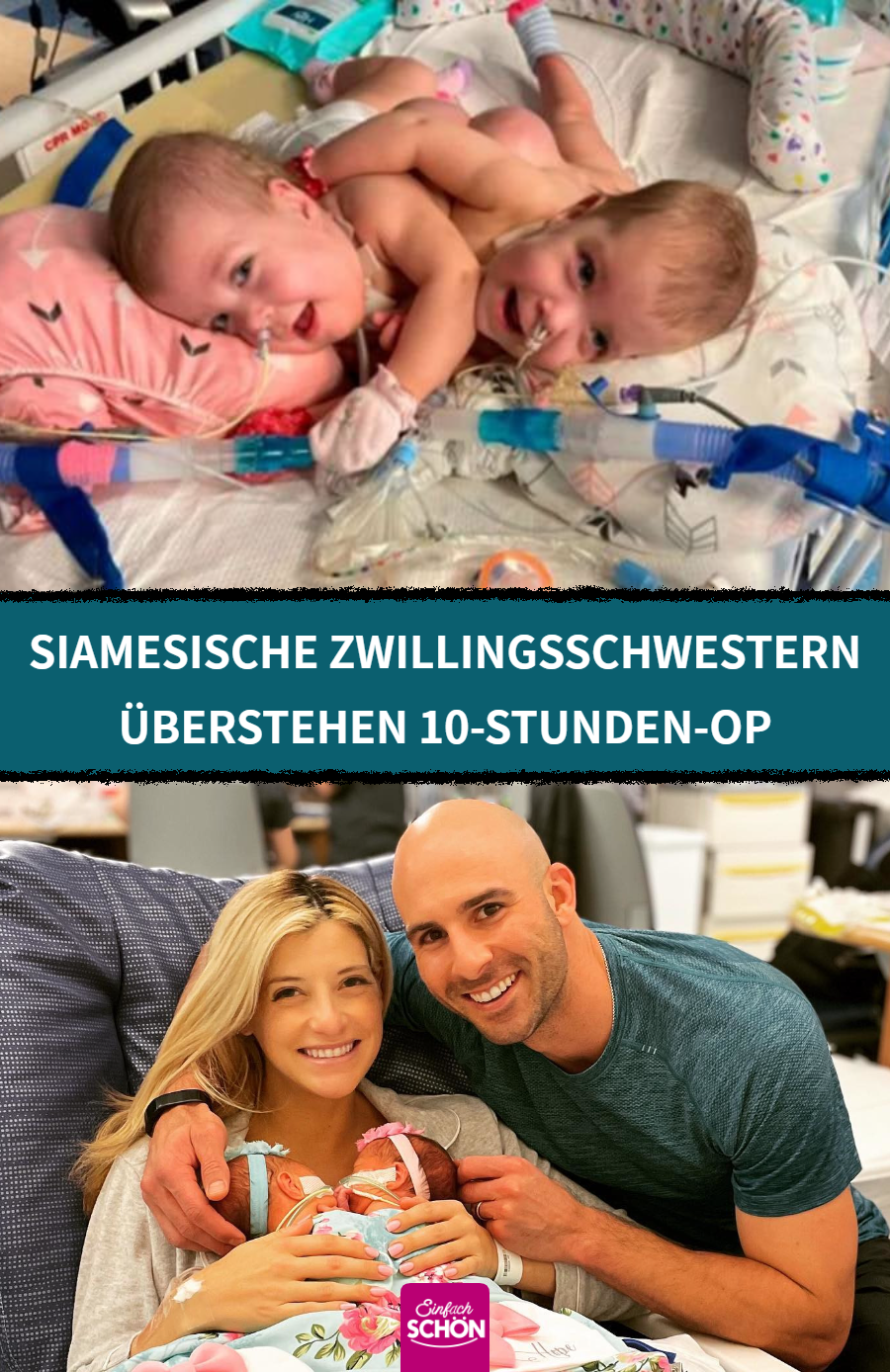 Siamesische Zwillinge werden in 10-stündiger OP getrennt